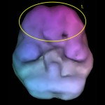Tip 1 – Klasični add (ADHD)