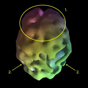 Alzheimerjeva bolezen