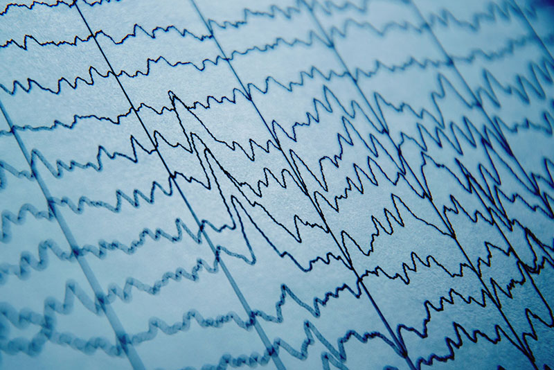 Nezgodne možganske poškodbe 5 - - Neuromedis - Neuromedis - eeg meritve