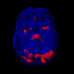 Fronto-temporalna demenca